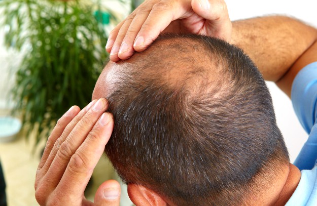 balding man holding head | Hair Loss Cure: Fact Or Fiction?