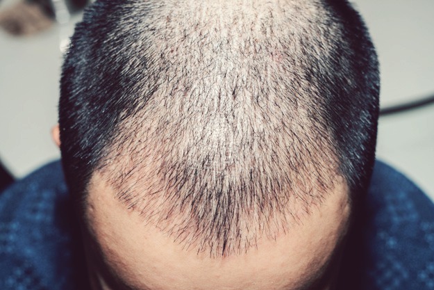 Top view man hair | Male Pattern Baldness | Symptoms, Causes And Prevention | Cure for baldness