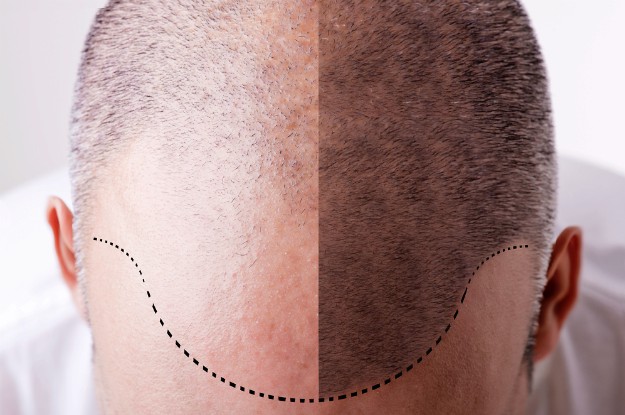 mens head receding hair stem cell | Hair Loss Cure: Fact Or Fiction?