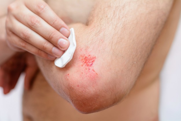 How to Tell If a Wound Is Healing or Infected | Treating and Dressing A Wound | Survival Skills Every Man Should Know